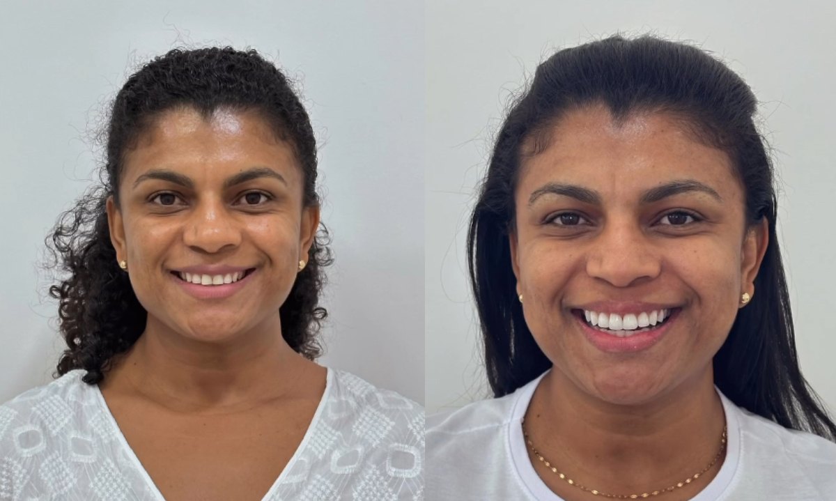 Antes e depois de facetas em resina
