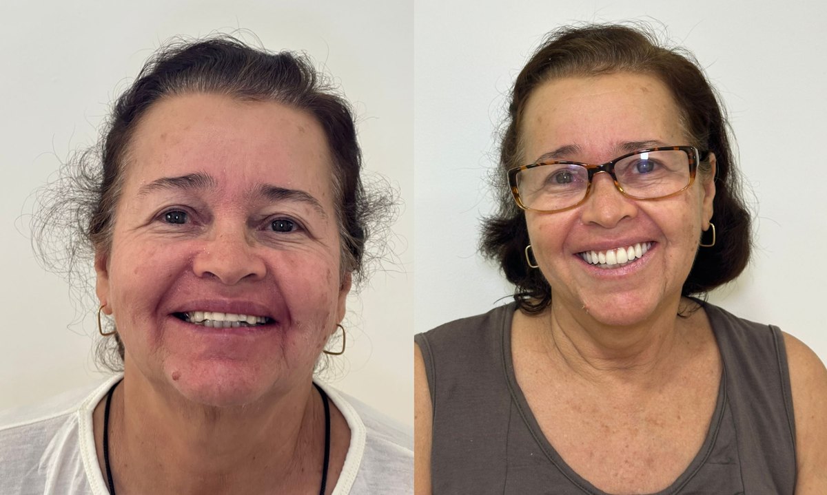 Antes e depois de prótese protocolo sobre implantes